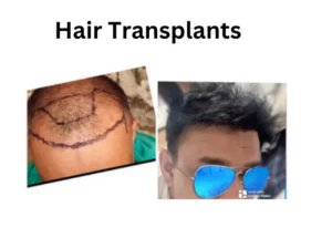 Best Hair transplant center in Faridabad