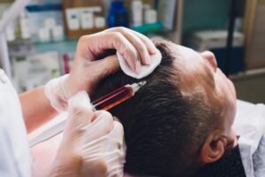 Best Hair Transplant Doctor in Faridabad