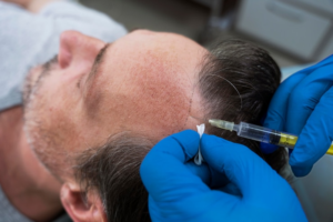 FUE technique hair transplant in Sector - 29, Faridabad