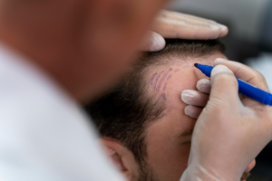 FUE hair transplant in Sector 29, Faridabad