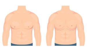 best gynecomastia surgery in Sector 29, Faridabad