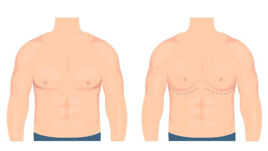 best gynecomastia surgery in Sector 29, Faridabad