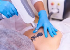 Best Permanent Tattoo Removal Treatment in Sector 29