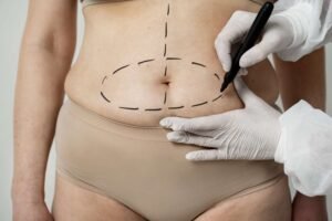 Best Liposuction Surgery Clinic in Sector 29