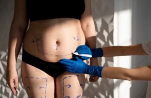 Best Liposuction for Fat Removal in Sector 29, Faridabad
