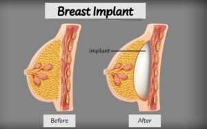 Best Breast Reduction surgery in Sector 29, Faridabad