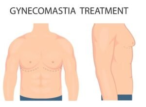 Best Gynecomastia Surgeon in Faridabad
