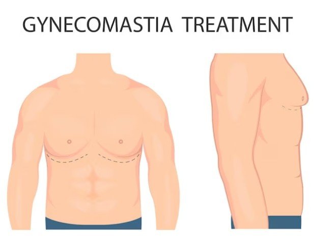 Best Gynecomastia Surgeon in Faridabad