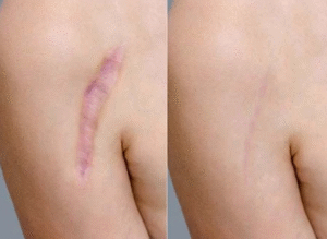 Best Scar Revision Surgery in Sector 30, Faridabad