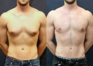 best Gynecomastia Treatment in Sector 30, Faridabad