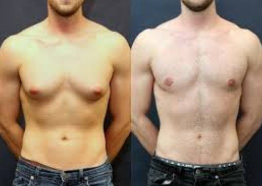 best Gynecomastia Treatment in Sector 30, Faridabad