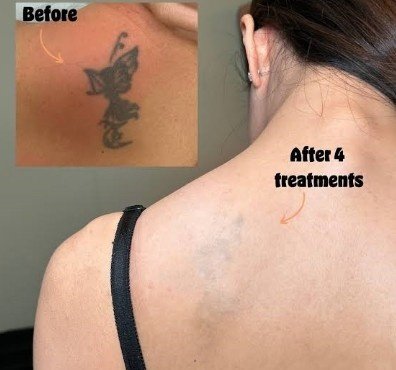 Best Laser Tattoo Removal Center in Sector 29, Faridabad