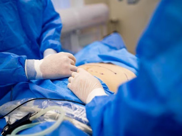 Surgeons performing abdominoplasty procedure at the clinic of the Top Tummy Tuck Surgeon in Sector 27A, Faridabad.