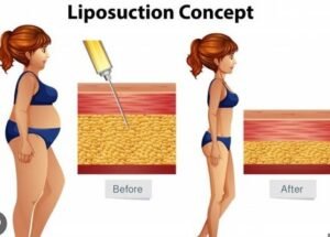 Best Liposuction Surgery in Sector 27C, Faridabad