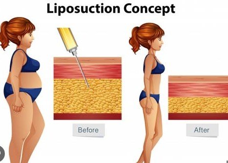 Best Liposuction Surgery in Sector 27C, Faridabad