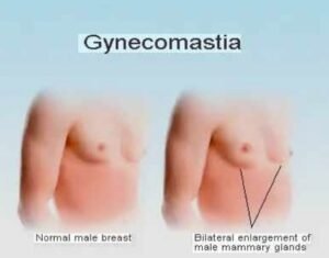 Best Gynecomastia Treatment in Sector 29, Faridabad