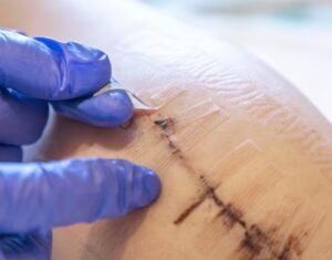 best scar removal treatment in Sector 27/A, Faridabad