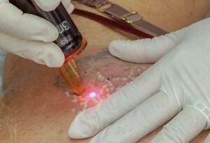 best laser technology for tattoo removal in Sector 65, Faridabad