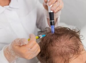 Best FUE Technique for Hair Fall in Sector 27C, Faridabad