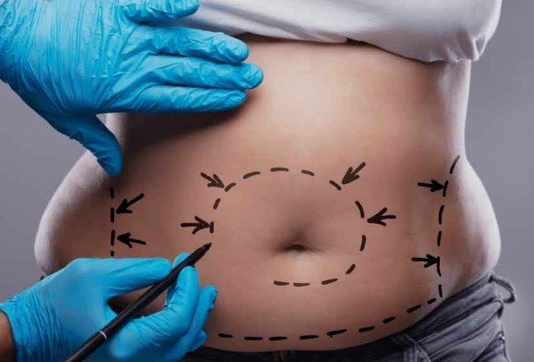Best Tummy Tuck Surgical Procedure in Sector 30, Faridabad